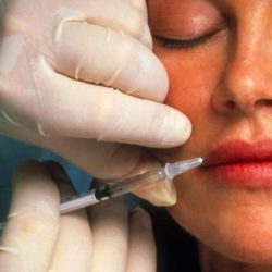 Most botox injections take place in milady