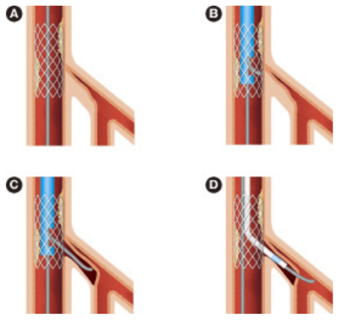 Patient side occluded alarm meaning