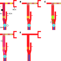 Iv pump occlusion