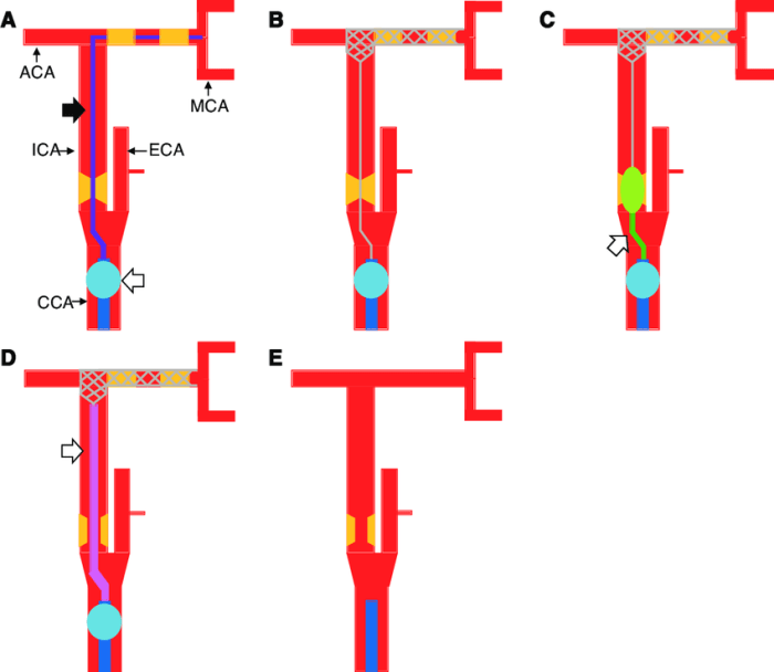 Iv pump occlusion